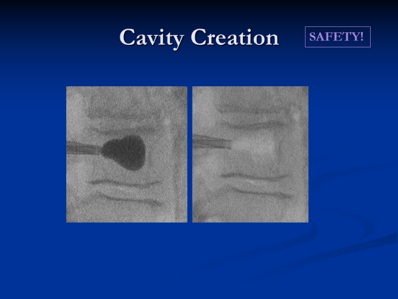 Cavity Creation SAFETY!